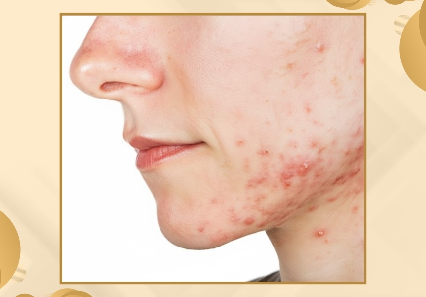 Concerned About Acne, Injury, or Surgical Scars?